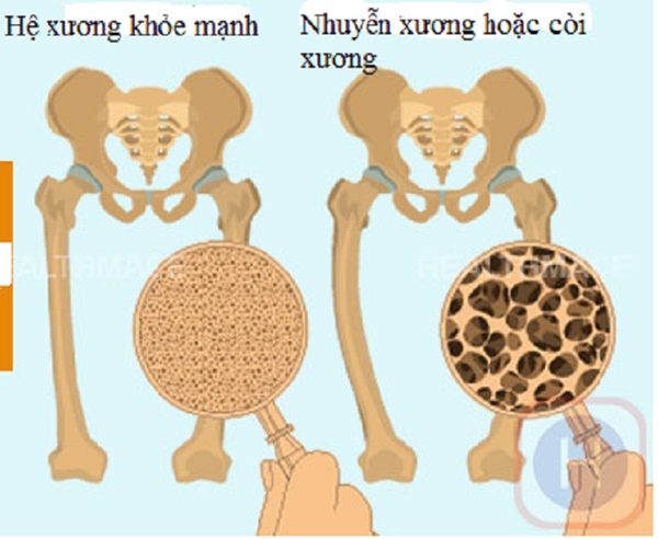 Người phụ nữ 34 tuổi bị nhuyễn xương do thiếu vitamin D: Dấu hiệu cảnh báo dễ nhận ra-2