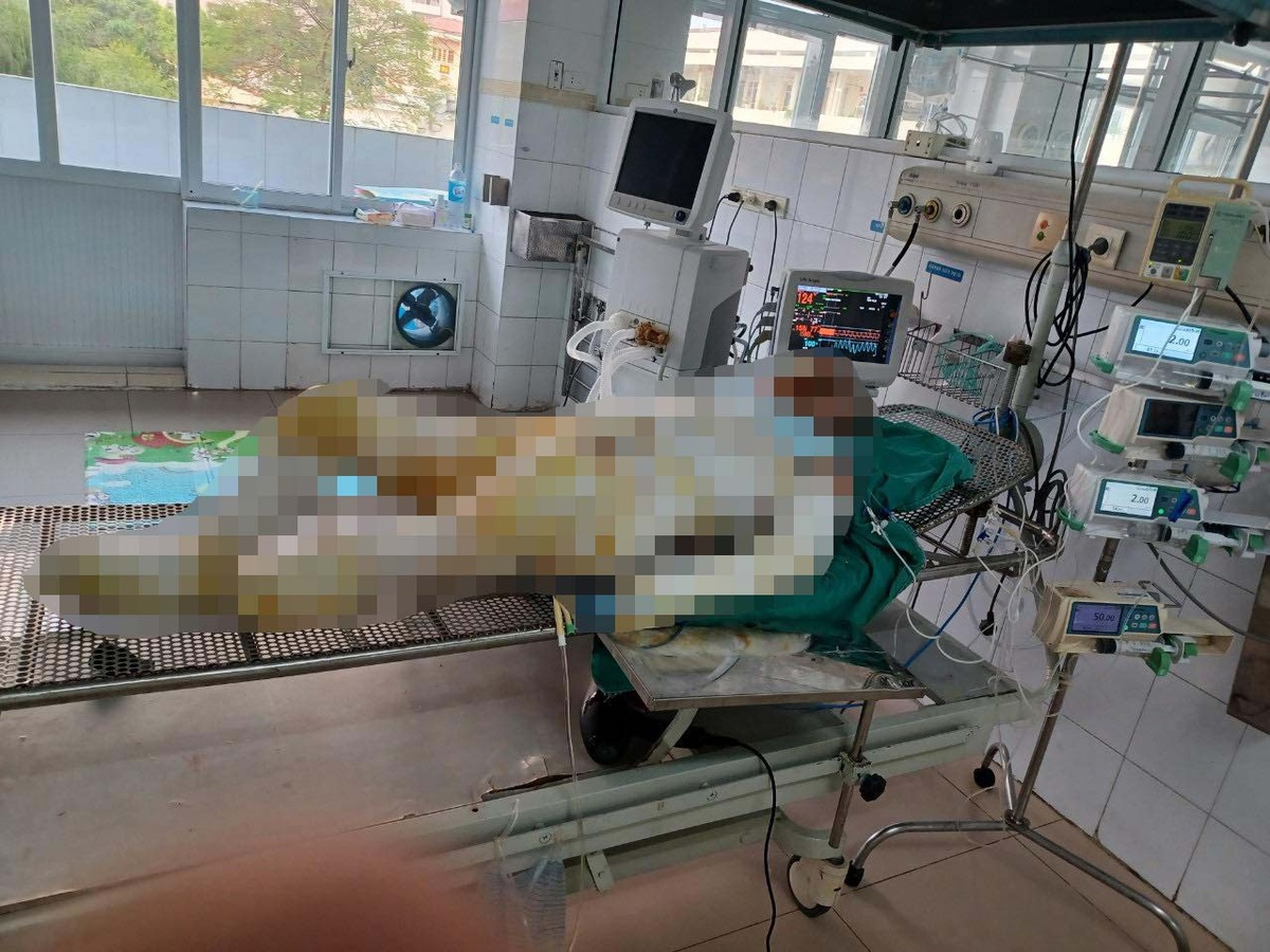 Vụ con gái phóng hỏa nhà mẹ: Người mẹ được ghép da-1