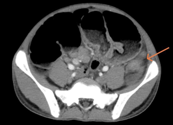 Vào viện vì đau bụng, trẻ 15 tuổi được chẩn đoán mắc ung thư-1