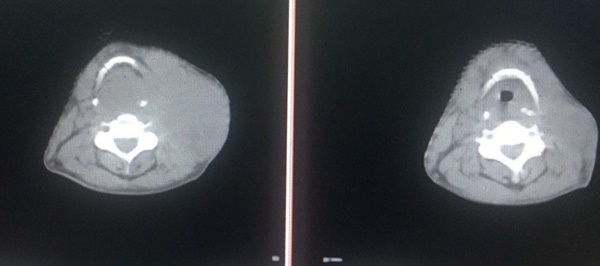 Chủ quan với dấu hiệu tưởng rất nhẹ, người đàn ông mắc ung thư-1