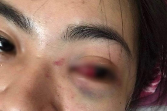 Nữ sinh lớp 11 bị nhóm bạn đánh tụ máu mắt