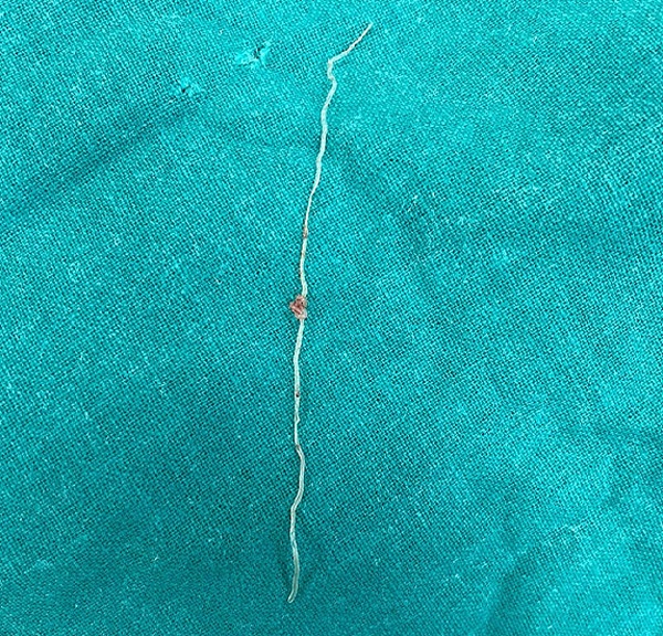 Phát hiện ký sinh trùng trong khối u trên má sau khi bị muỗi đốt-1