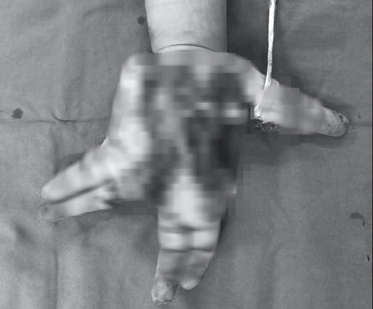 Thiếu niên 14 tuổi nát bàn tay do nổ điện thoại-1