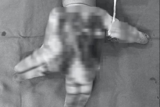 Thiếu niên 14 tuổi nát bàn tay do nổ điện thoại