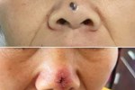 Phát hiện ung thư từ sự thay đổi bất thường của nốt ruồi ở mũi
