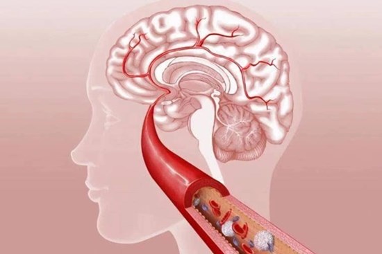 Người đàn ông 46 tuổi tử vong đột ngột vì nhồi máu não, bác sĩ nói: 3 thói quen cần thay đổi trước khi đi ngủ
