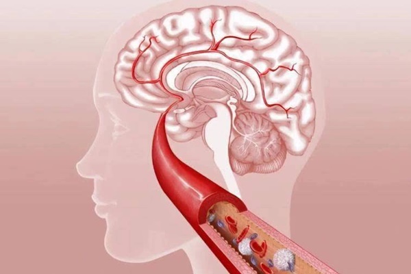 Người đàn ông 46 tuổi tử vong đột ngột vì nhồi máu não, bác sĩ nói: 3 thói quen cần thay đổi trước khi đi ngủ-3