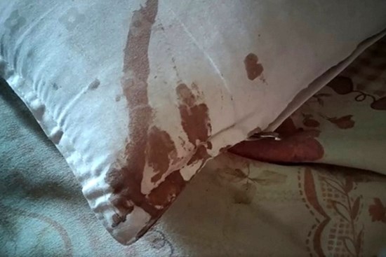 Thức giấc vì đau, người đàn ông sợ hãi thấy tai mình bị chuột cắn nham nhở