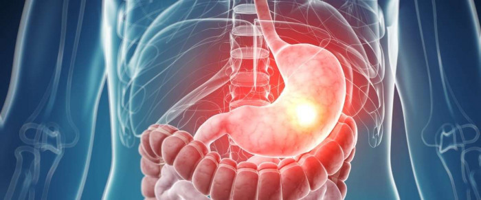 Chàng trai 26 tuổi mắc ung thư dạ dày giai đoạn cuối, nếu xuất hiện 5 dấu hiệu này cần nội soi ngay-3