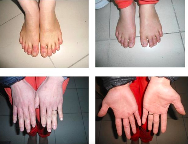 Ngón tay, chân sưng và ngứa vào mùa đông, xử trí ra sao?-1