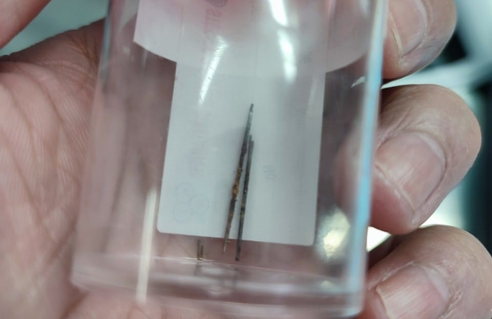 Bất ngờ phát hiện kim khâu nằm trong phổi bé trai 4 tuổi-1