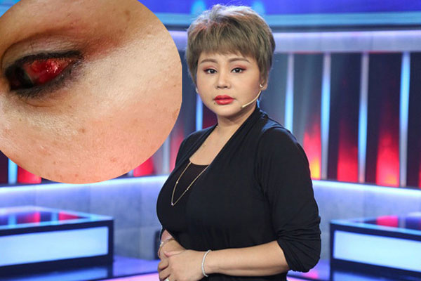 Lê Giang tiếp tục thẩm mỹ sau 10 lần sửa mũi, 2 lần độn cằm-3