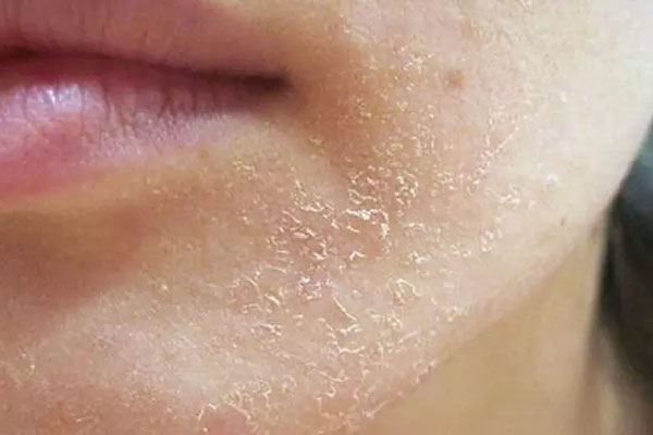 Ba nguyên tắc cơ bản giảm khô nẻ, bong tróc da-1