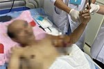 Nối bàn tay bị đứt lìa do tai nạn cho bé trai 21 tháng tuổi-3