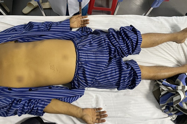 Người đàn ông 40 tuổi nguy kịch vì loại xoắn khuẩn hiểm-1