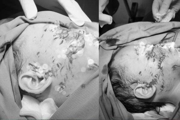 Bé 28 tháng tuổi bị chó cắn gây tổn thương nghiêm trọng vùng mặt-1