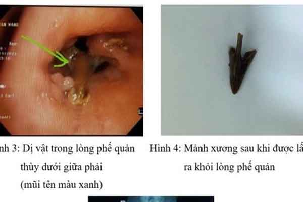 Người đàn ông phải nhập viện sau 1 tháng sặc thịt gà-1