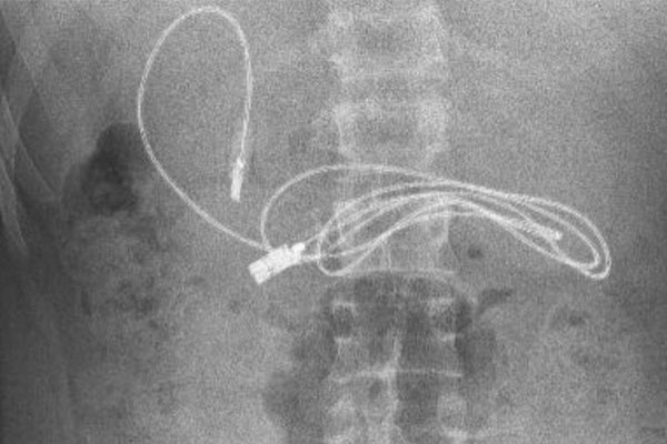 Thiếu niên 15 tuổi nhập viện vì có dây sạc dài gần 1 mét trong dạ dày-1