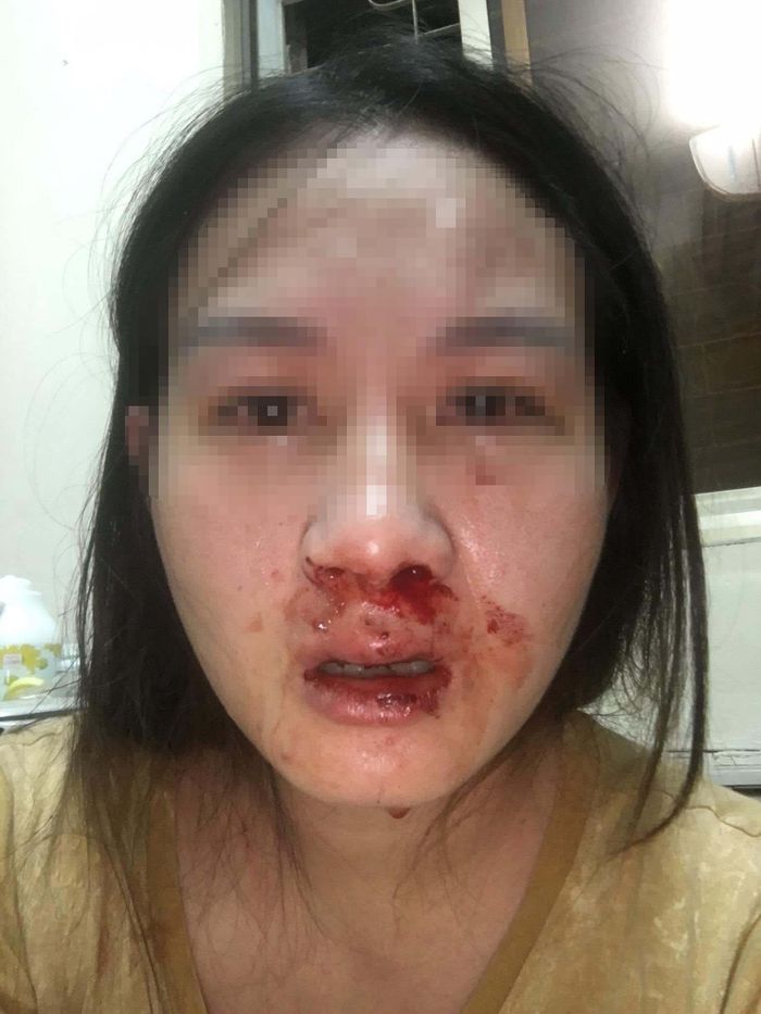 Hà Nội: Một cán bộ công an bị tố đánh vợ con bầm dập-1