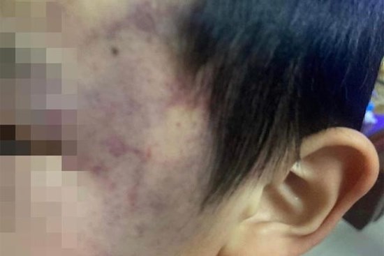 Bé trai 4 tuổi bị con cô giáo đánh tại trường