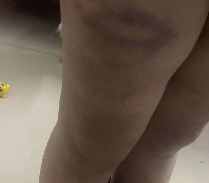 Bé trai 4 tuổi bị con cô giáo đánh tại trường-2