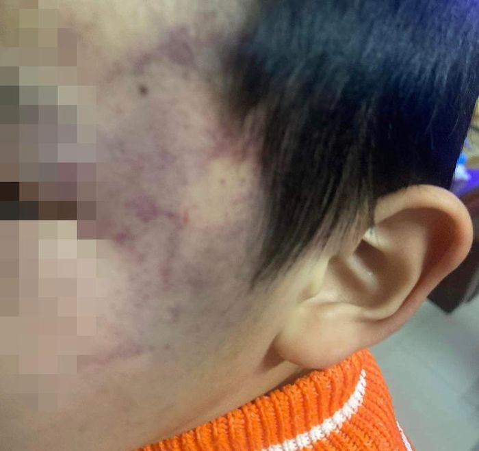 Bé trai 4 tuổi bị con cô giáo đánh tại trường-1