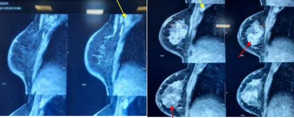 Trì hoãn đi khám, người phụ nữ nhận kết quả mắc ung thư di căn-1