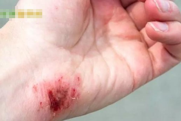 Người đàn ông suýt tử vong sau khi chế biến cá, đừng chủ quan với loại vết thương này-1