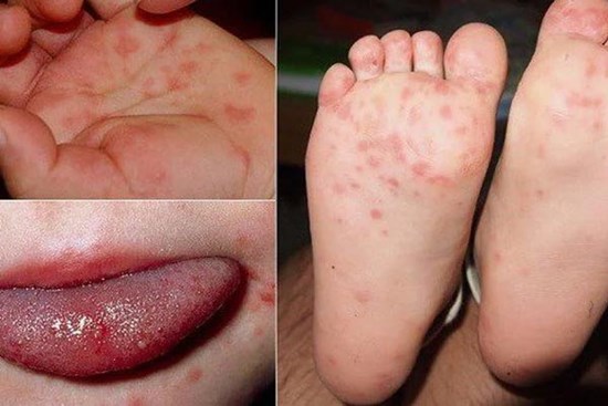 Trẻ bị chân tay miệng nên tắm lá gì?