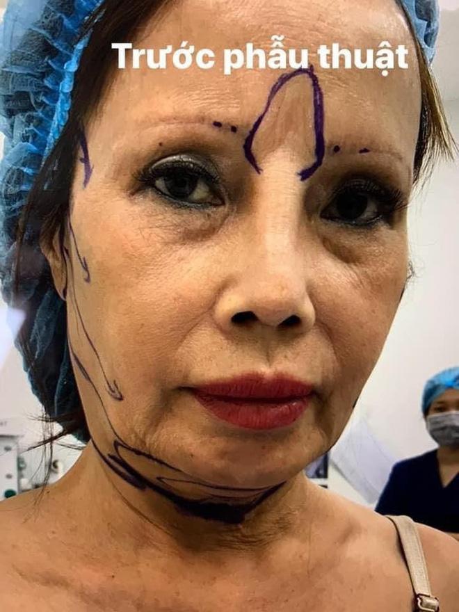 Nhan sắc cô dâu Cao Bằng sau 3 năm dao kéo biến chứng-4