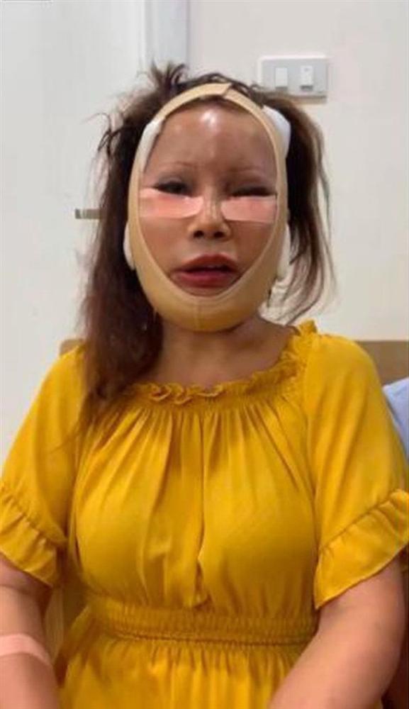 Nhan sắc cô dâu Cao Bằng sau 3 năm dao kéo biến chứng-5