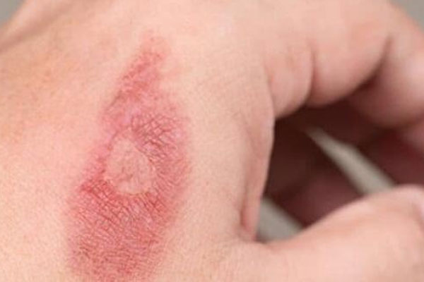 Không chườm đá lên vết bỏng, 5 bước sơ cứu cần nhớ nằm lòng khi bị bỏng-1