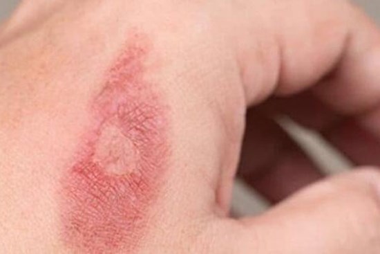 Không chườm đá lên vết bỏng, 5 bước sơ cứu cần nhớ 'nằm lòng' khi bị bỏng