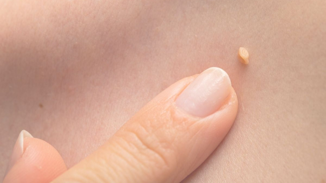 Bệnh tình dục gia tăng ở nhóm người trẻ, có người điều trị sùi mào gà 15 lần không khỏi-3