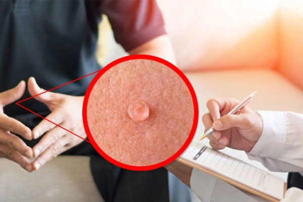 Nam sinh 18 tuổi mắc cùng lúc sùi mào gà và HIV-2