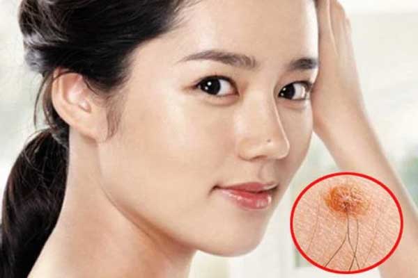 Nốt ruồi mọc lông ngồi không cũng có lộc?-3