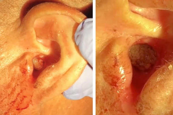 Đau tai dữ dội và chảy máu, người đàn ông kinh hoàng phát hiện cả tổ ký sinh trùng đang ăn mòn màng nhĩ bên trong-1