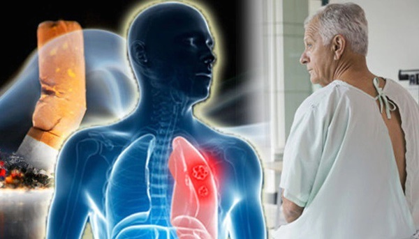 Những loại ung thư phổ biến nam giới nên tầm soát trước tuổi 35-1