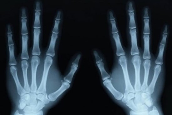 Đến khi nào xương của trẻ ngừng phát triển?