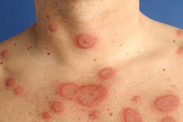 Ngứa khắp người không chỉ là dấu hiệu của bệnh ngoài da-1