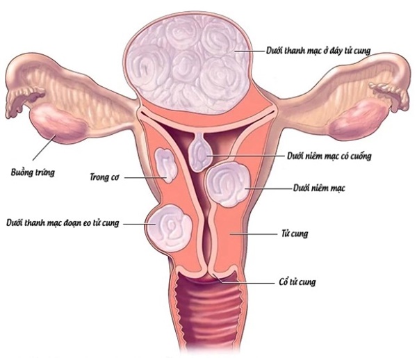 Phát hiện những bất thường này cần đi khám u tử cung ngay lập tức-1