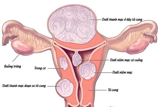 Phát hiện những bất thường này cần đi khám u tử cung ngay lập tức
