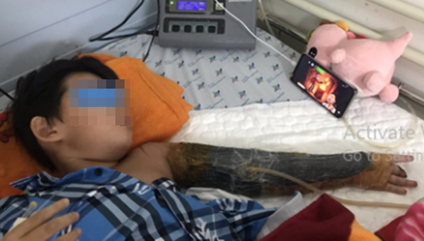 Vào công trình xây dựng chơi, bé trai 7 tuổi bị máy trộn bê tông làm dập nát cánh tay-1