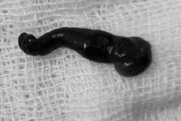 Liên tục chảy máu cam, người phụ nữ phát hiện đỉa trong mũi-2