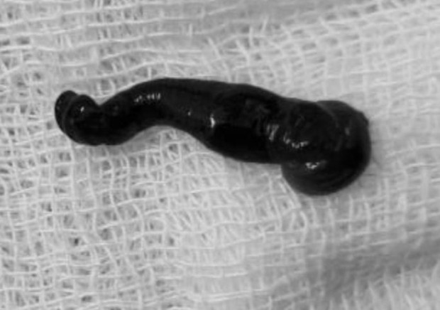 Phát hiện con đỉa dài 5 cm sống trong mũi thiếu niên 15 tuổi-1