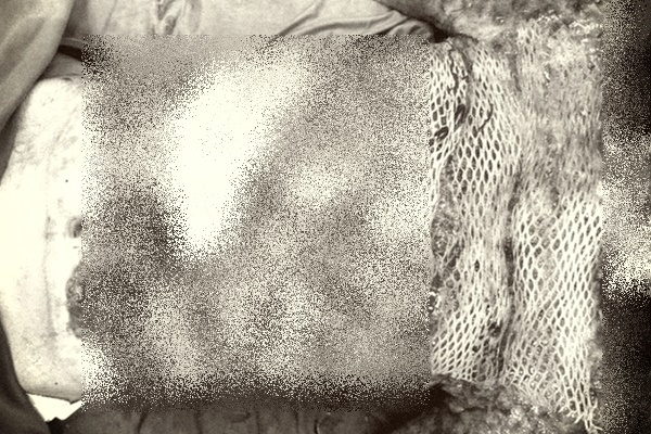 Cảnh báo tình trạng đắp thuốc chữa bỏng cho trẻ-1