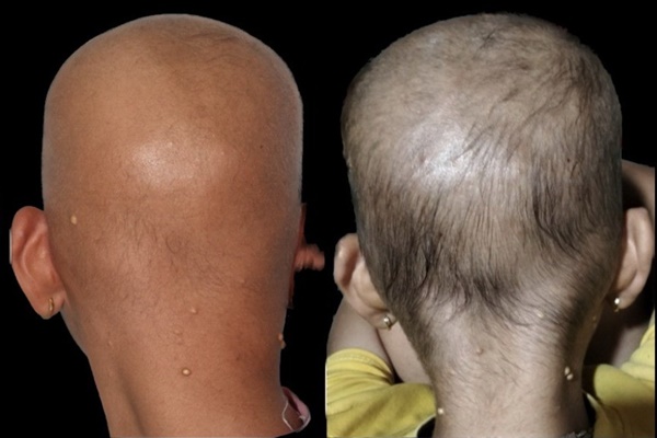 Sau cơn sốt, cô giáo mầm non liệt toàn thân, nguy kịch vì bệnh cực kỳ hiếm gặp-3