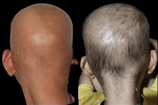 Căn bệnh hiếm khiến bé gái nổi hạt kê, trọc đầu nhiều năm