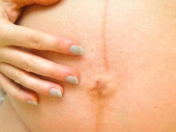 Đường sọc nâu mẹ bầu nào cũng có trên bụng khi mang thai tiết lộ điều gì?-1