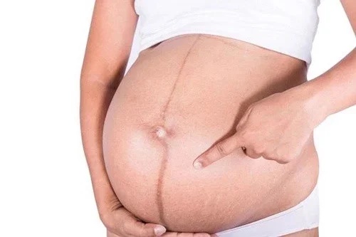 Đường sọc nâu mẹ bầu nào cũng có trên bụng khi mang thai tiết lộ điều gì?-2